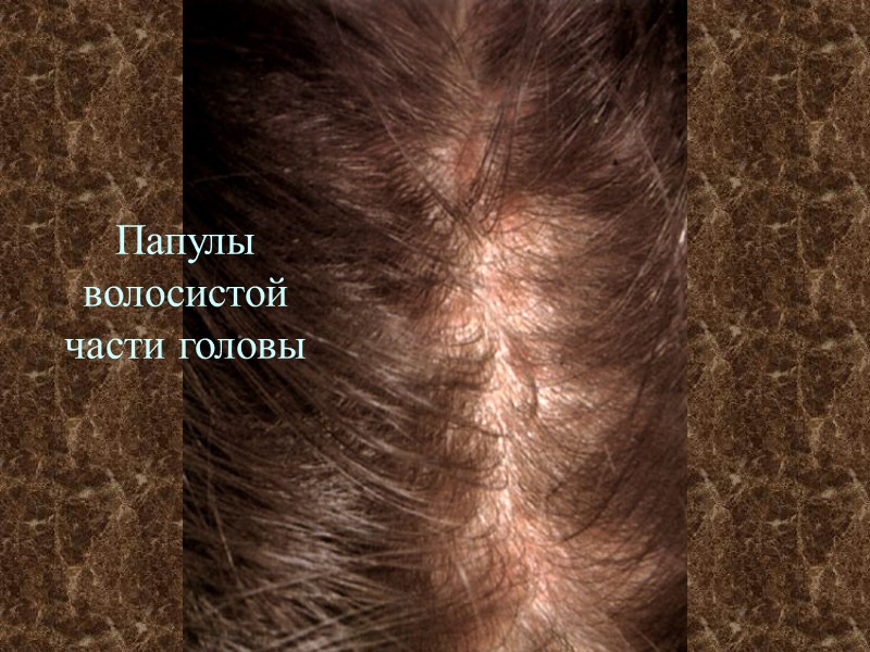 Папулы волосистой части головы